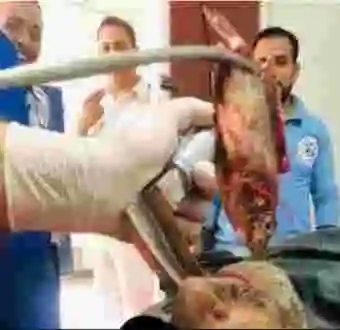 Moment doctors remove live fish from a fisherman's throat (video)