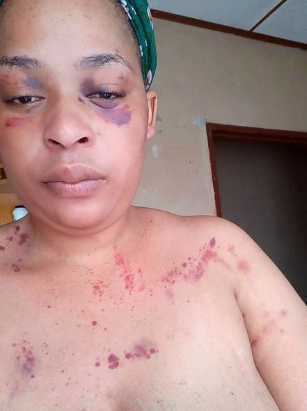 I Need Justice - South African Woman Says After She Was Brutalized By Her Police Officer Boyfriend