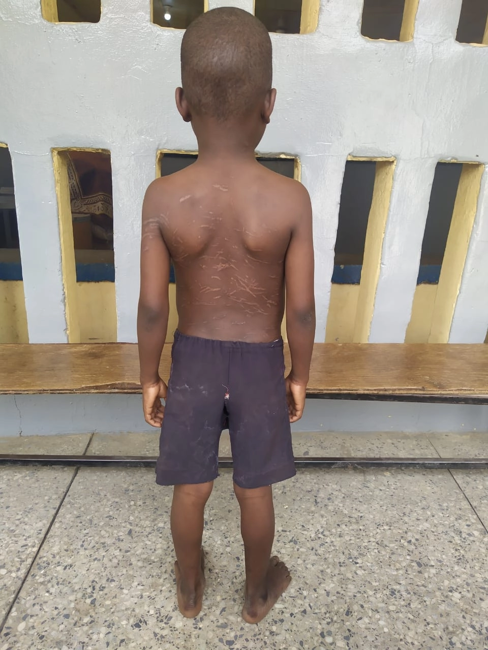 Kano police arrest teacher for gruesome torture of 8-year-old boy